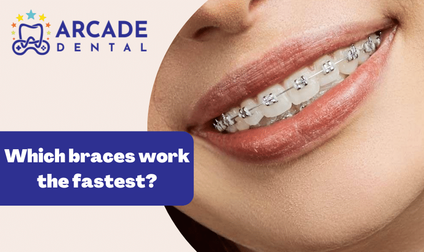 Ceramic vs. Metal Braces: Find The Best Option.