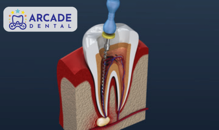 What To Do If Your Root Canal Gets Infected