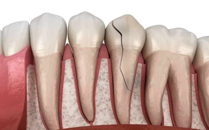 cracked tooth goes untreated