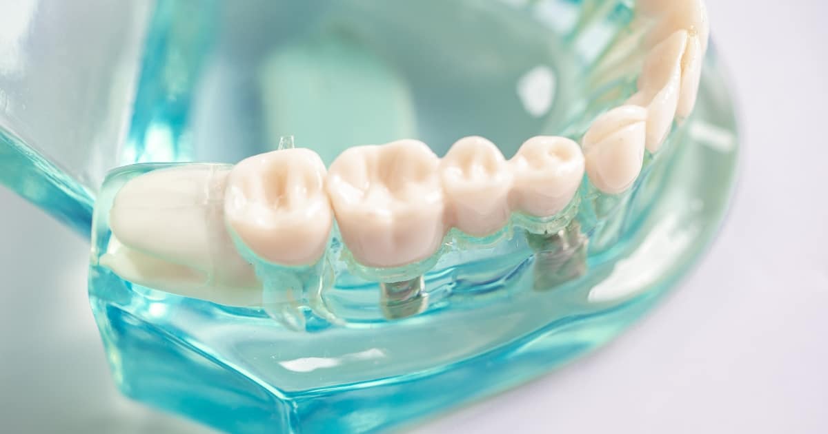 dental bridges vs. dental implants what’s best for you