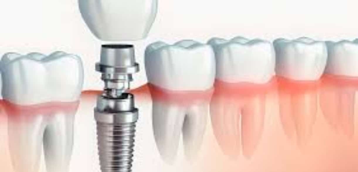 can dental implants in pharr improve your oral health the hidden benefits