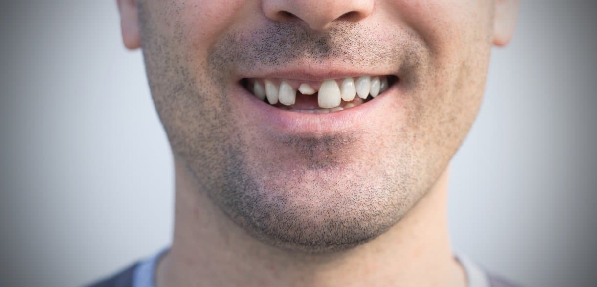 why you shouldnt ignore a cracked tooth